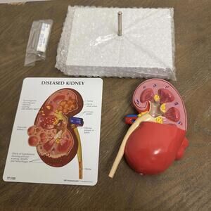 GPI Anatomicals Diseased Kidney Cancer  Medical Training Aid Anatomy Model #3260